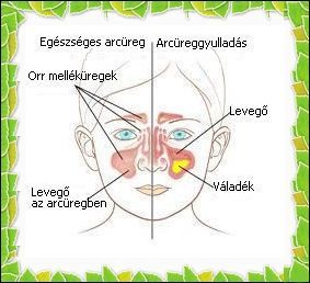 Sinusitis maxillaris - Arcreggyullads
